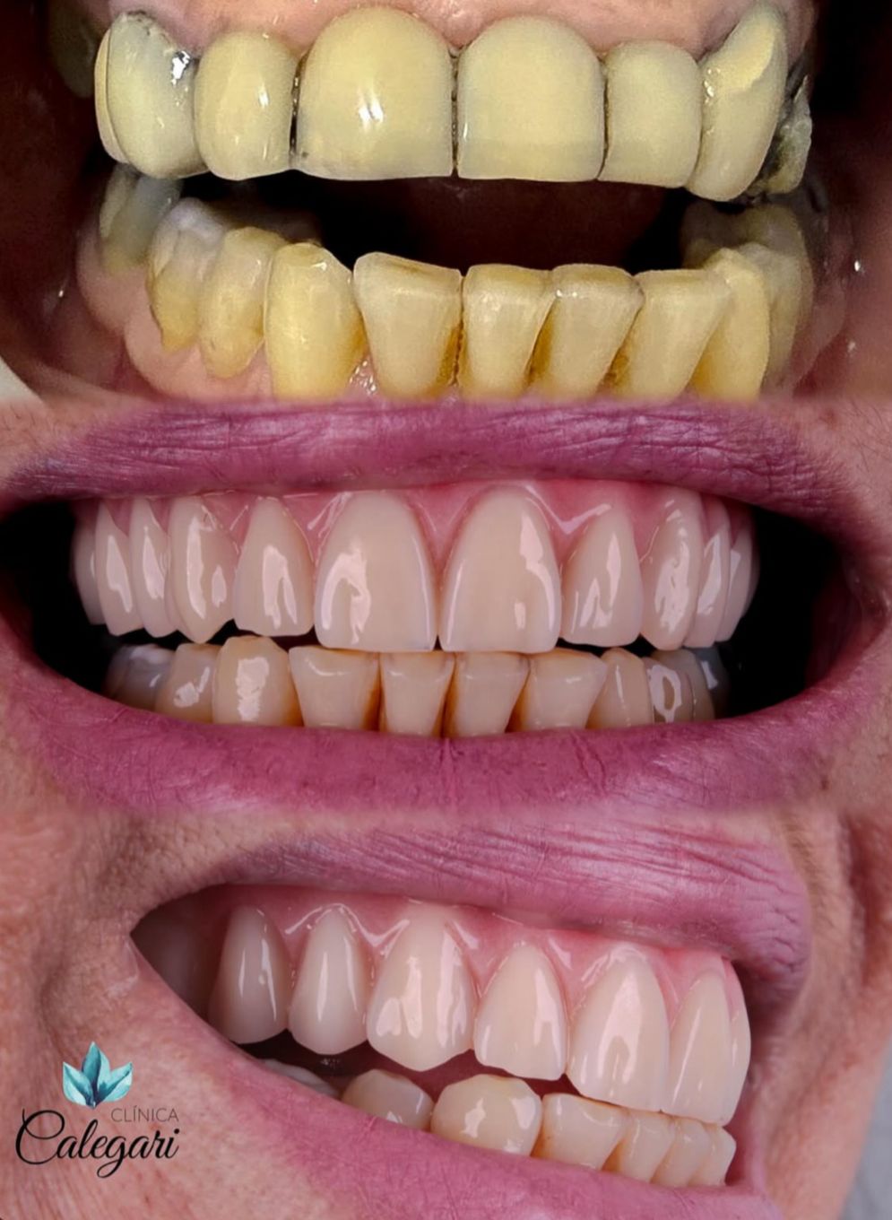 resultados reais 1 implantes dentarios