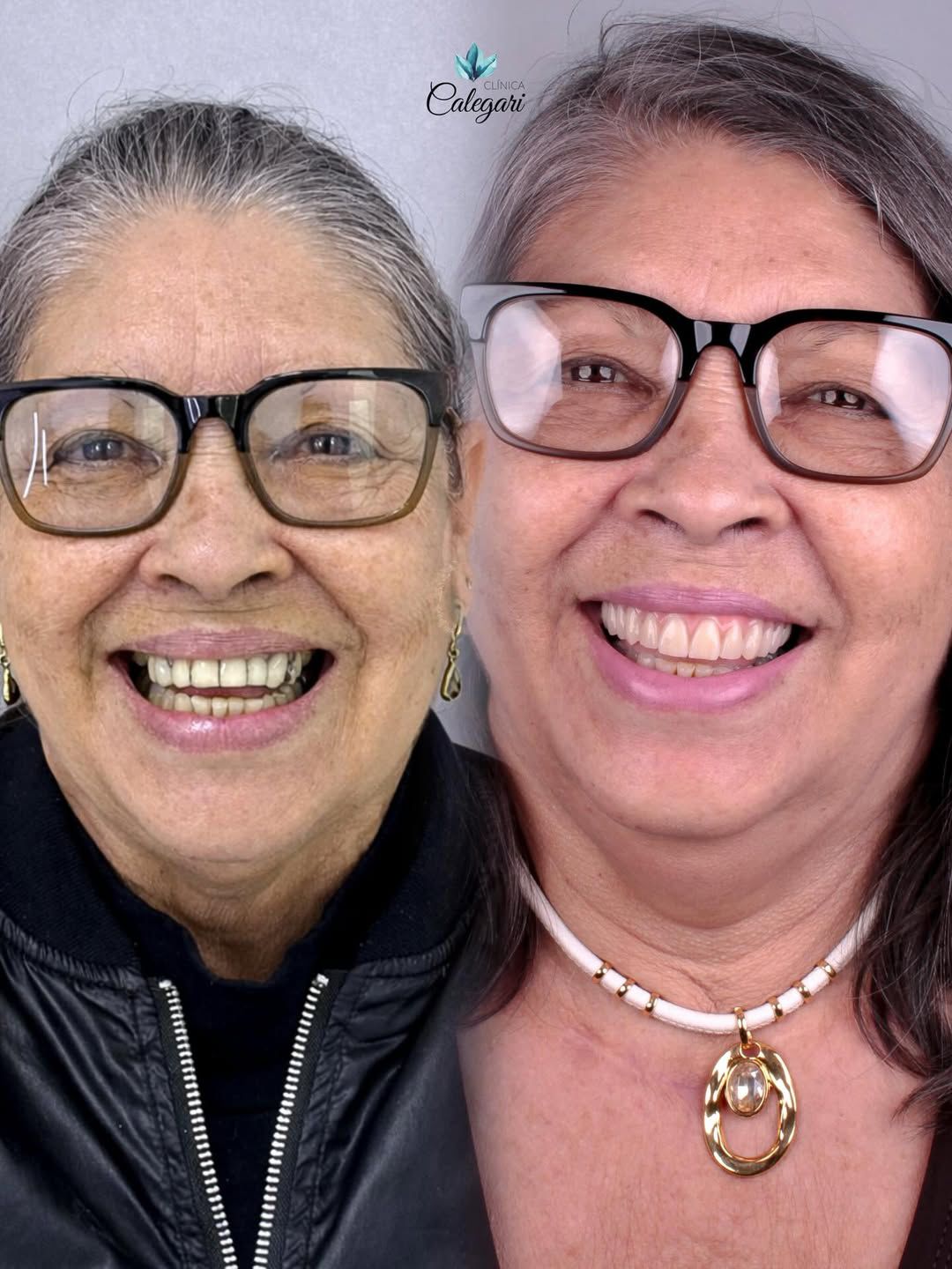resultados reais 2 implantes dentarios