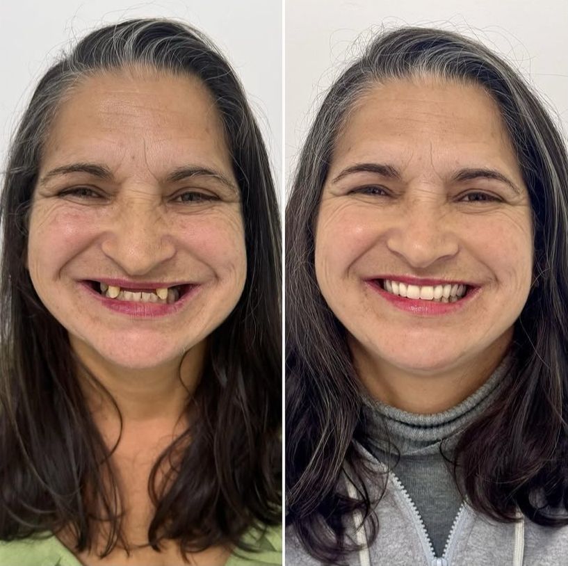 resultados reais 3 implantes dentarios