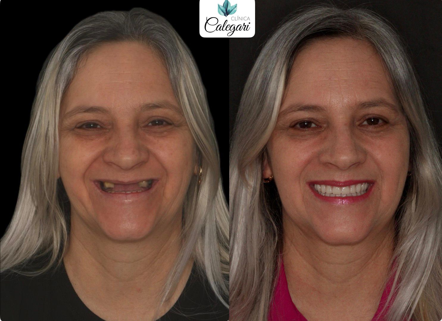 resultados reais 4 implantes dentarios
