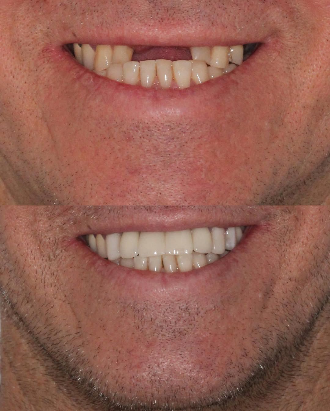 resultados reais 5 implantes dentarios