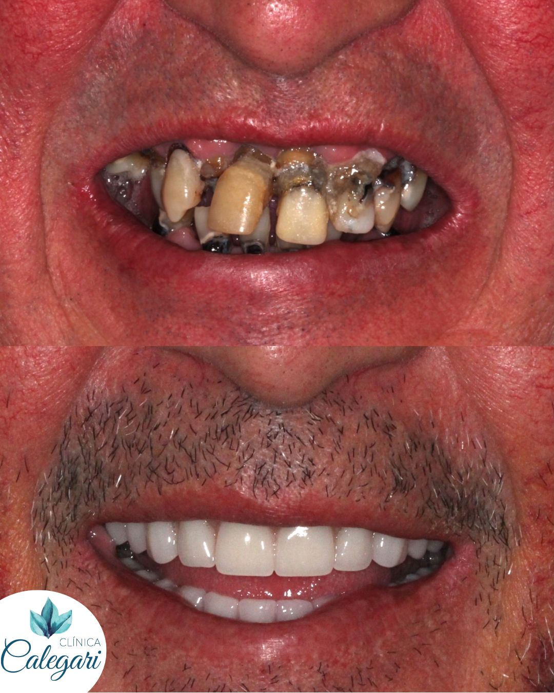 resultados reais 6 implantes dentarios