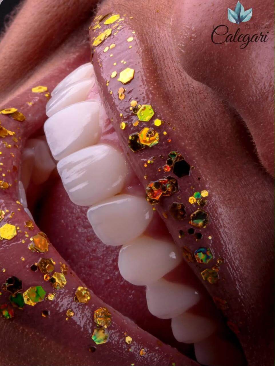 resultados reais 11 implantes dentarios