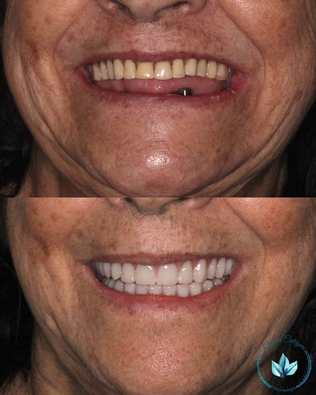 resultados reais 12 implantes dentarios