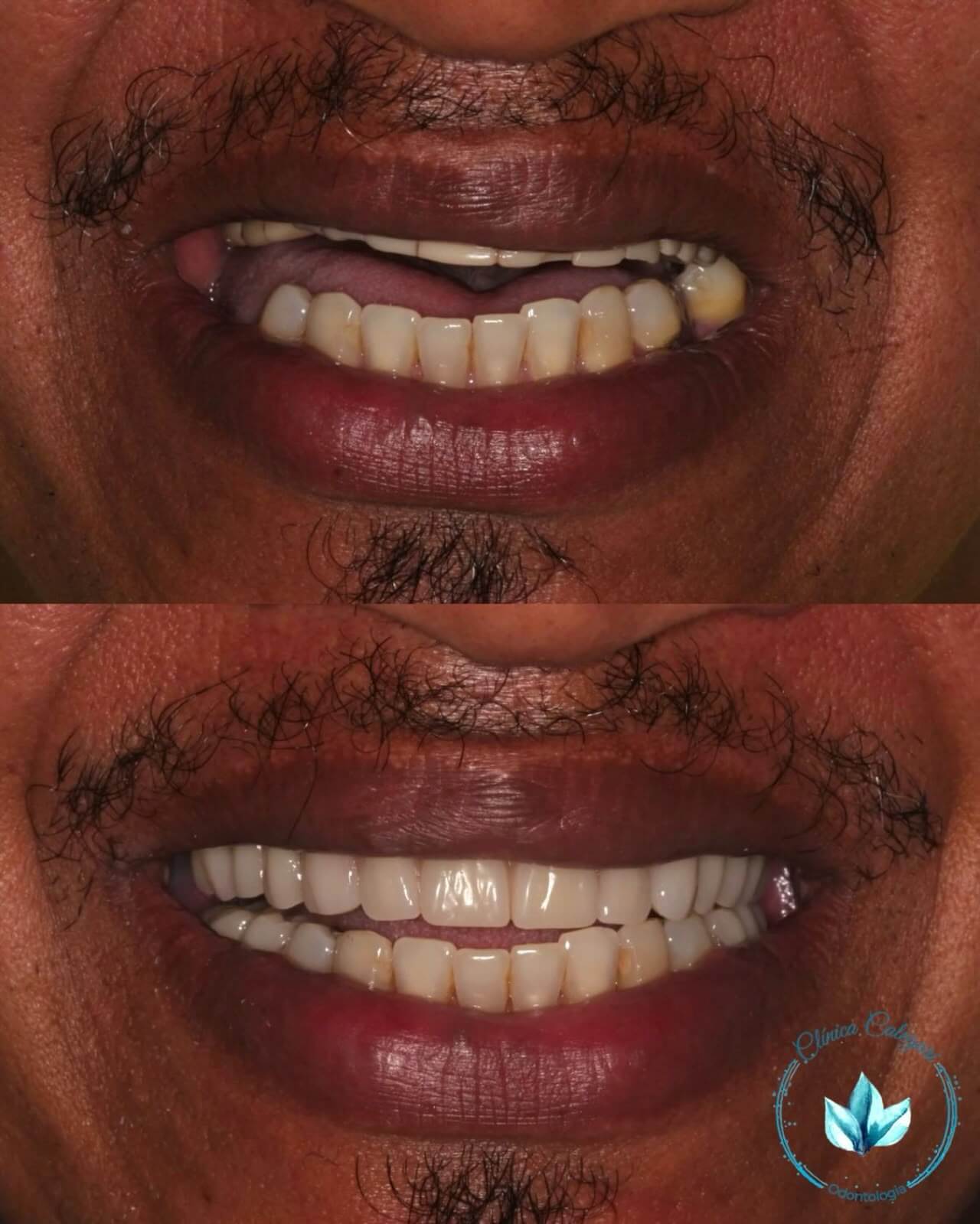 resultados reais 13 implantes dentarios