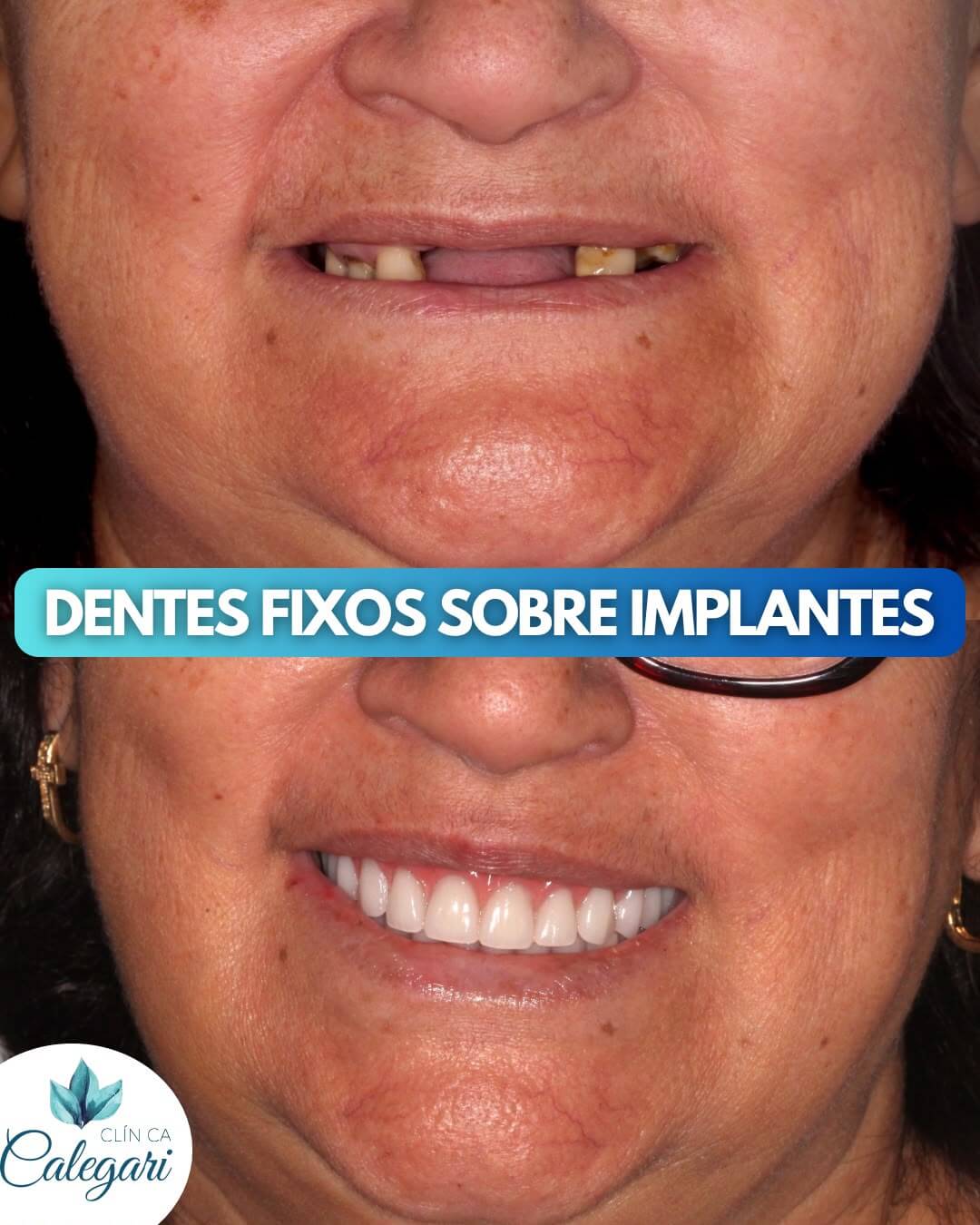 resultados reais 14 implantes dentarios